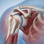 rupture du tendon