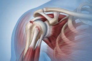 rupture du tendon