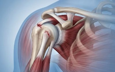 rupture du tendon