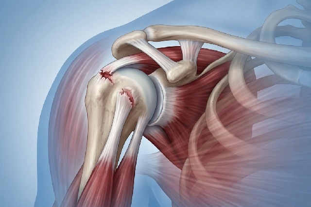 rupture du tendon
